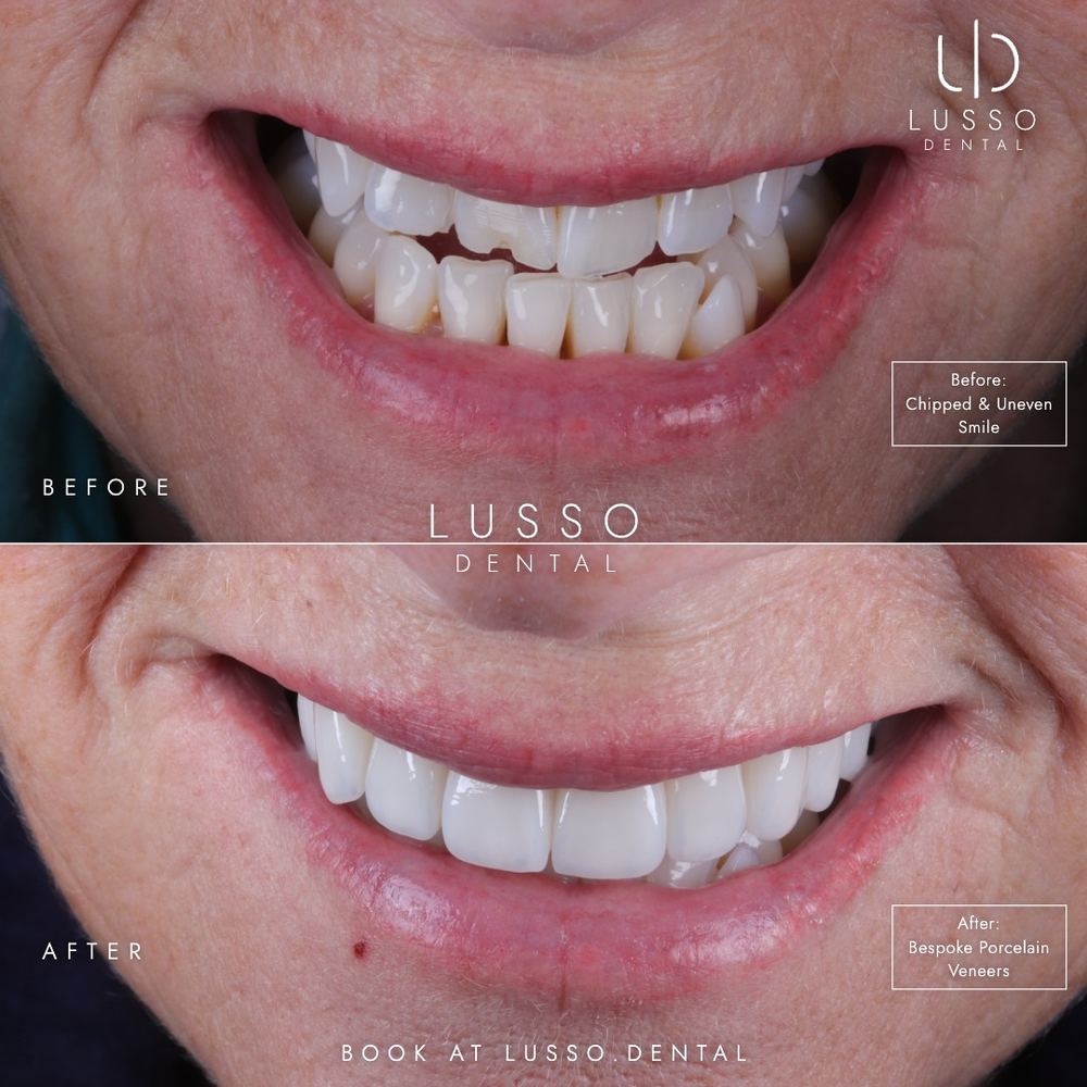 Porcelain veneers, before and after case 5, Dr Kal's own work