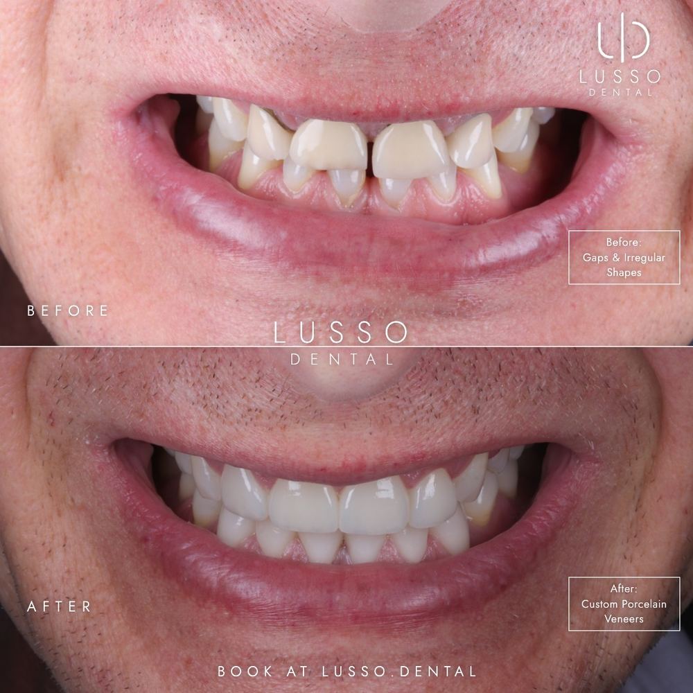 Porcelain veneers, before and after case 6, Dr Kal's own work