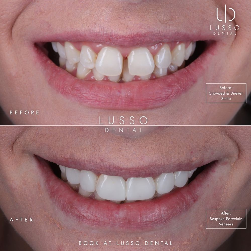 Porcelain veneers, before and after case 7, Dr Kal's own work