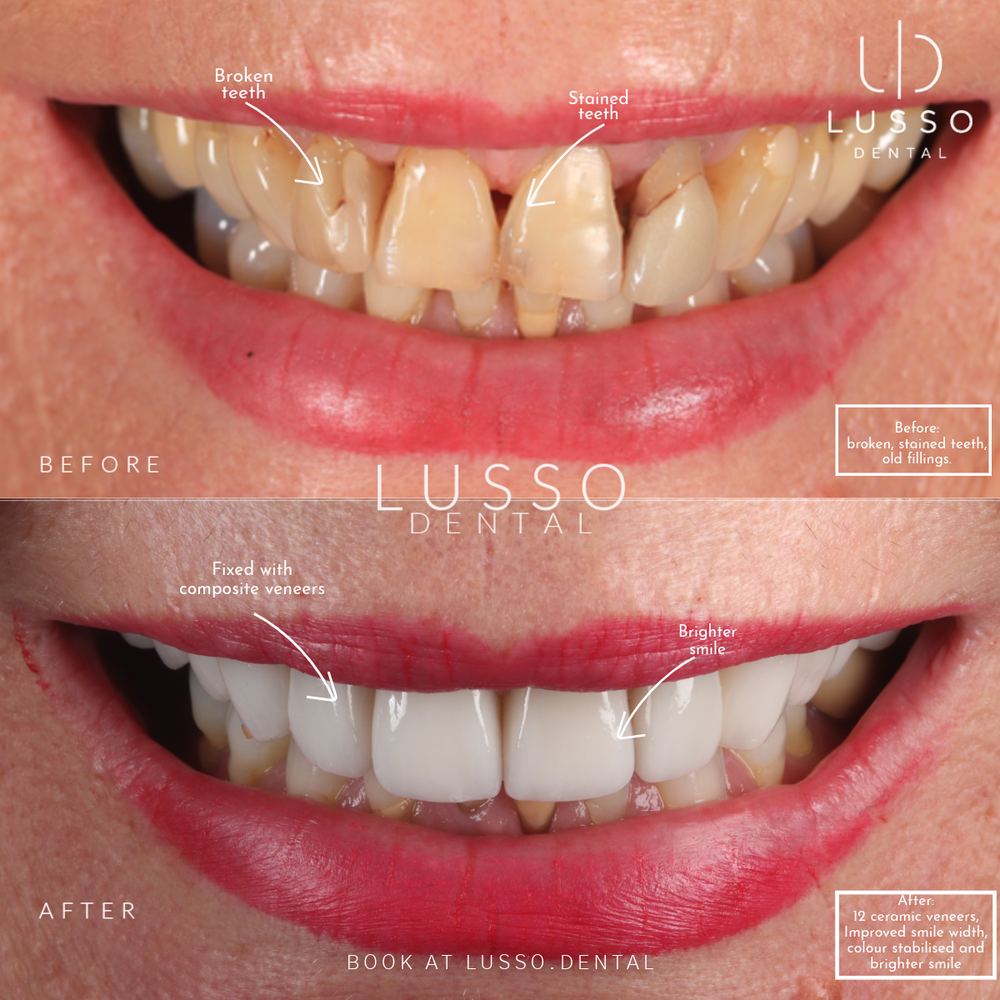 Porcelain veneers, before and after case 9, Dr Kal's own work