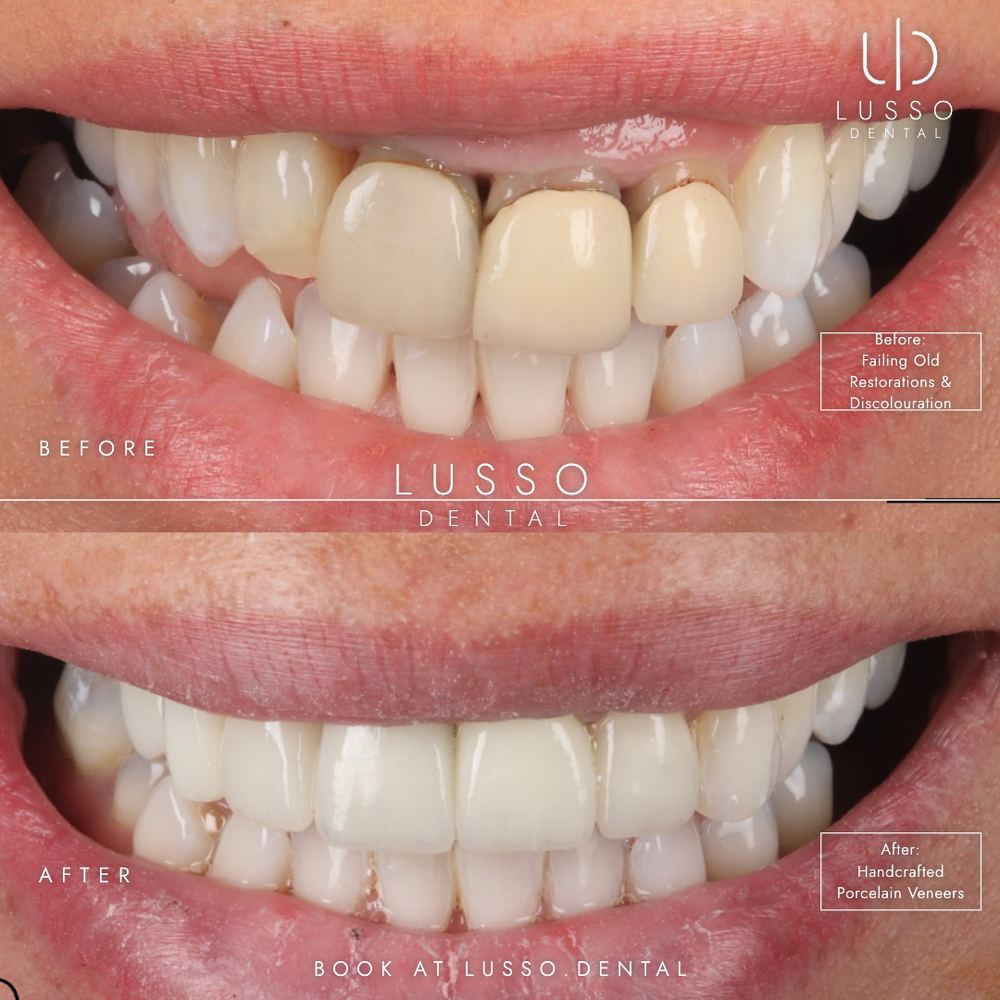 Porcelain veneers, before and after case 10, Dr Kal's own work