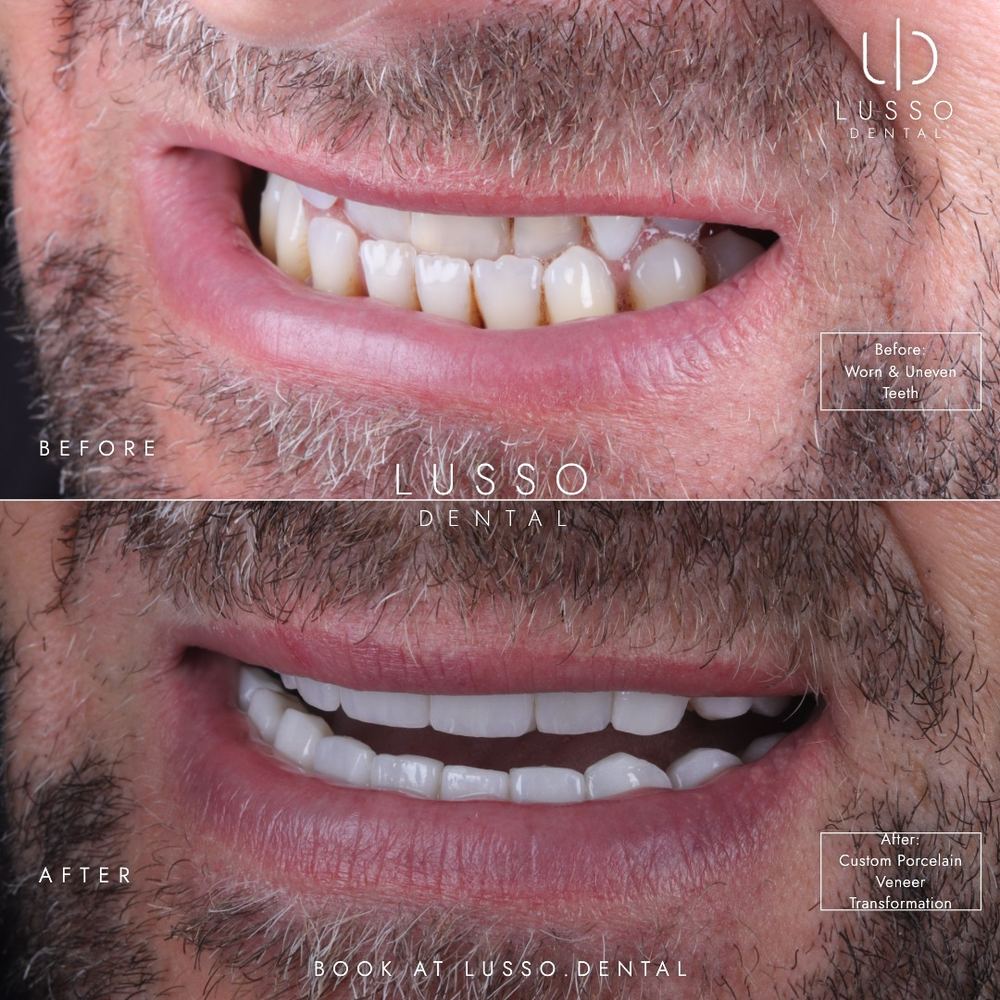 Porcelain veneers, before and after case 11, Dr Kal's own work