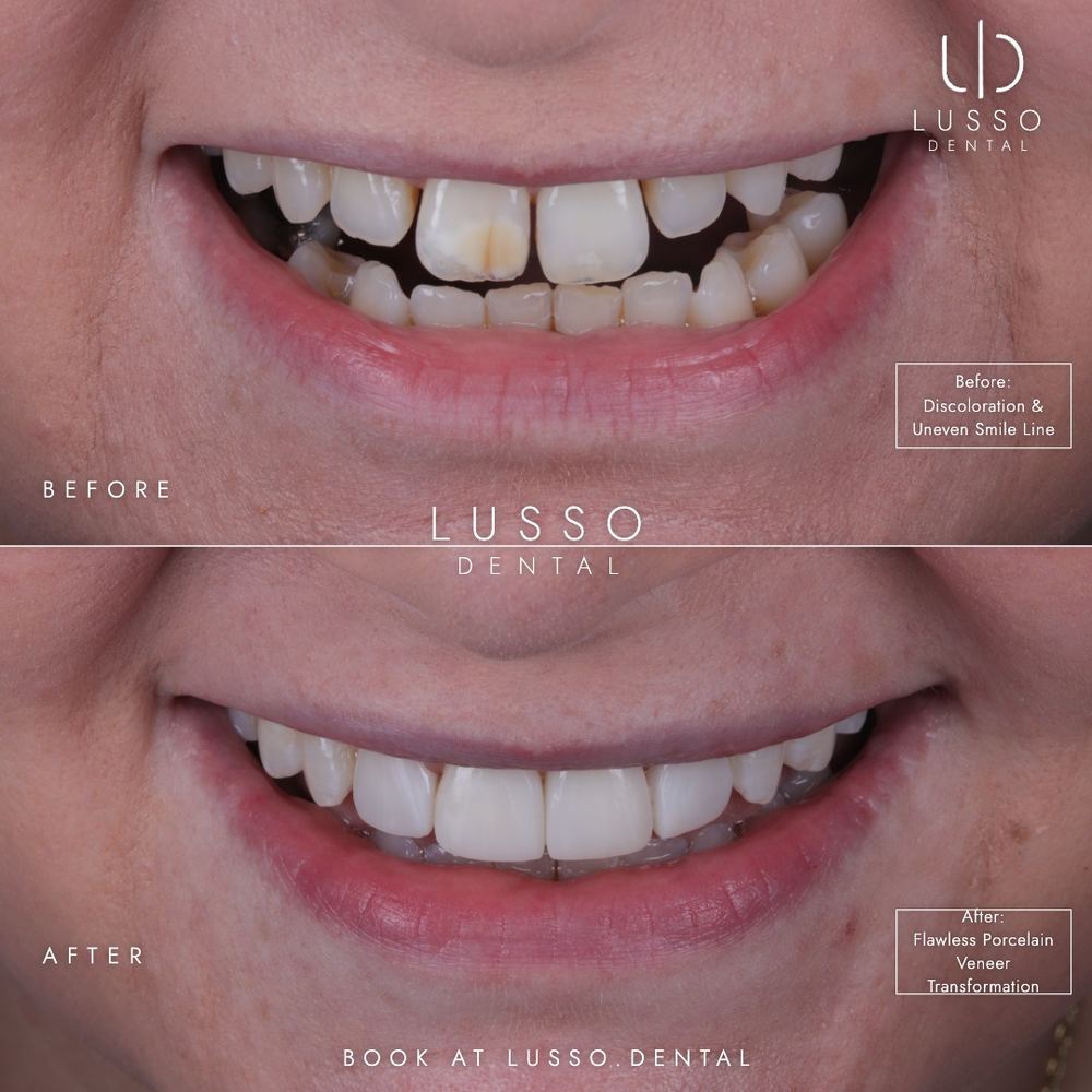 Porcelain veneers, before and after case 12, Dr Kal's own work