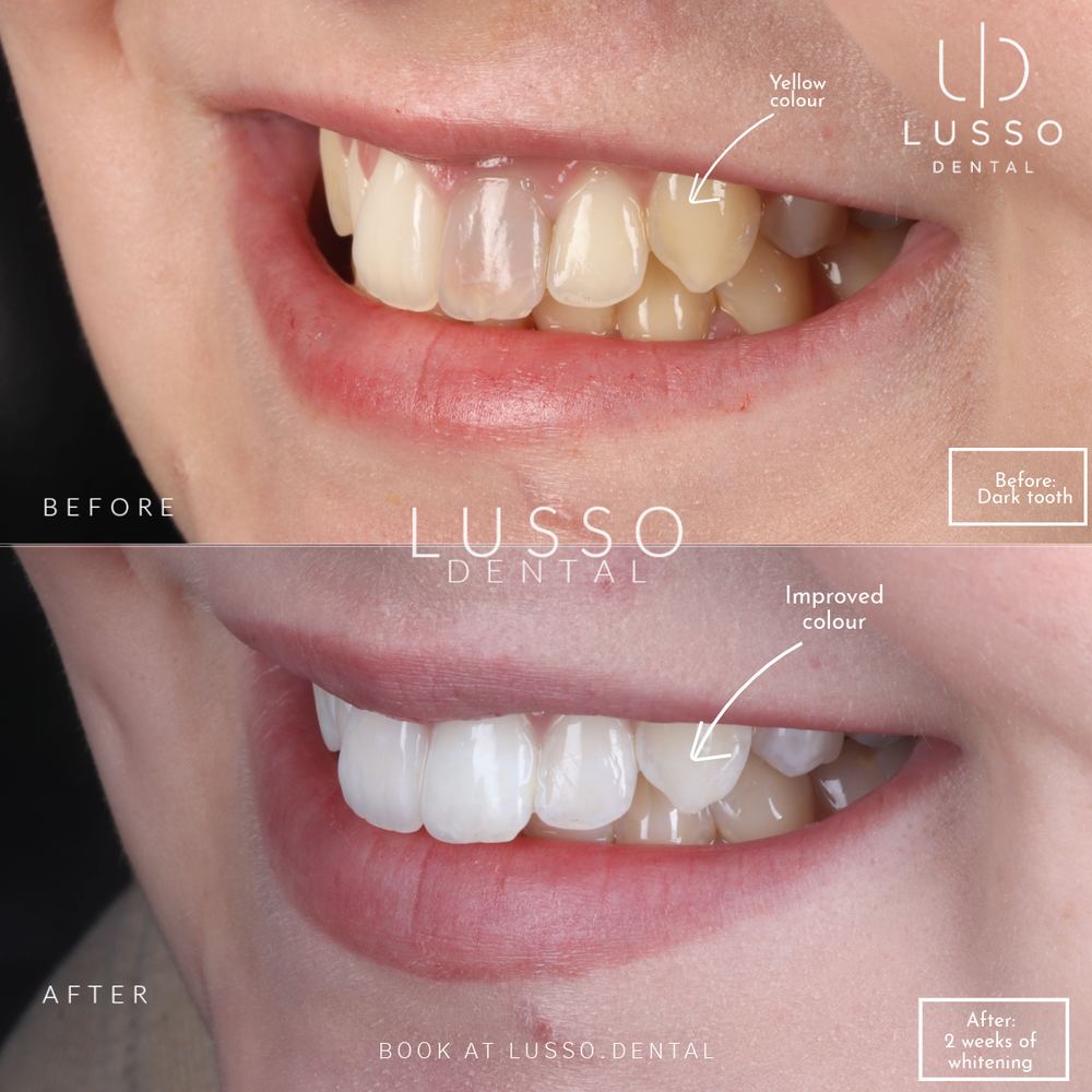 Teeth whitening, before and after case 1, Dr Kal's own work