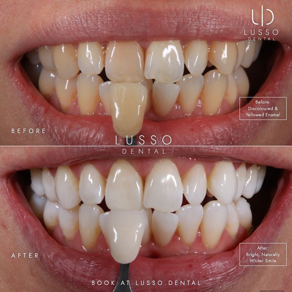 Teeth whitening, before and after case 2, Dr Kal's own work