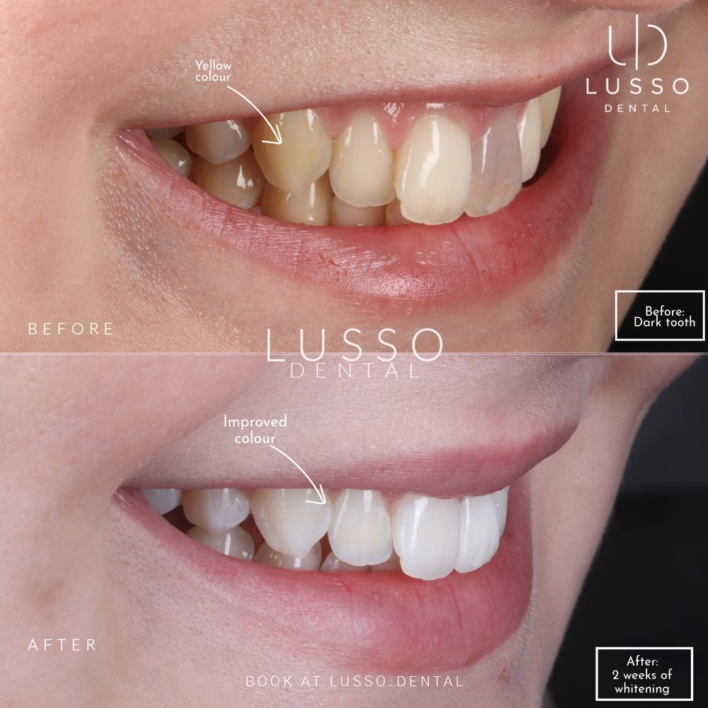 Teeth whitening, before and after case 3, Dr Kal's own work
