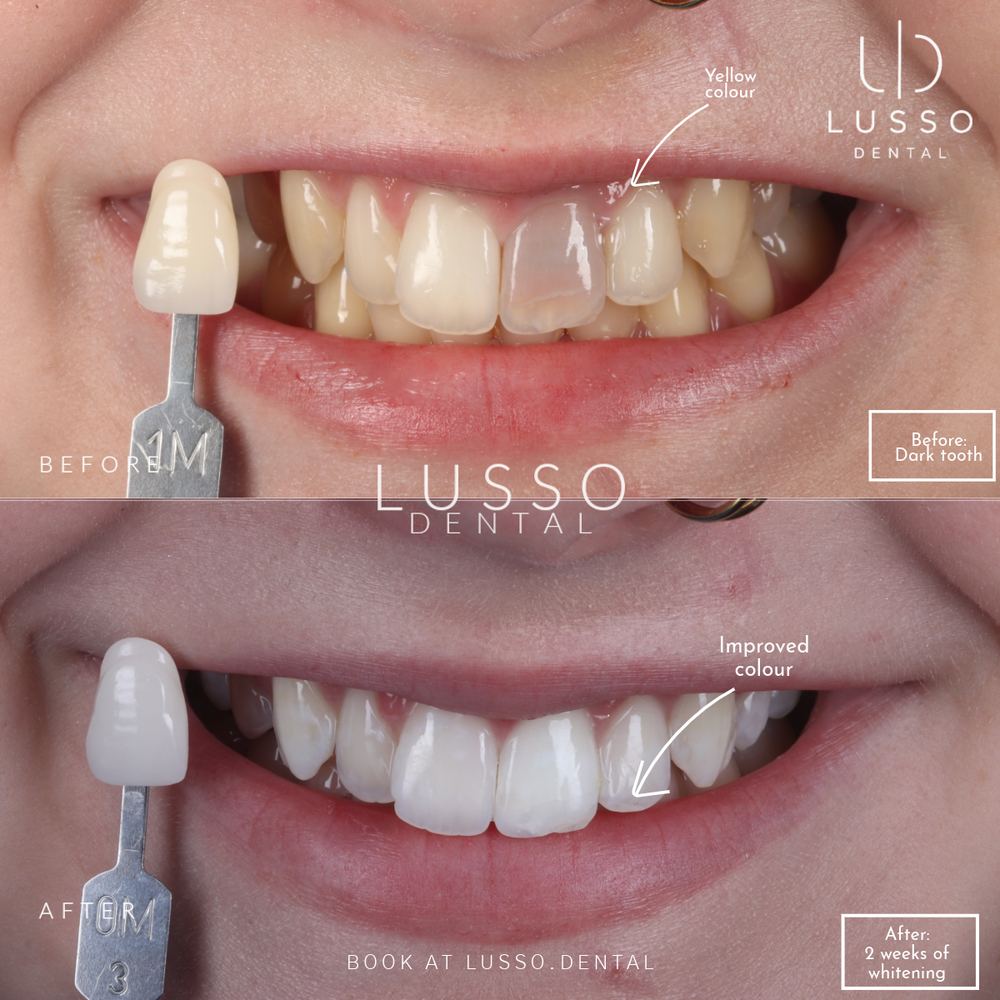 Teeth whitening, before and after case 4, Dr Kal's own work