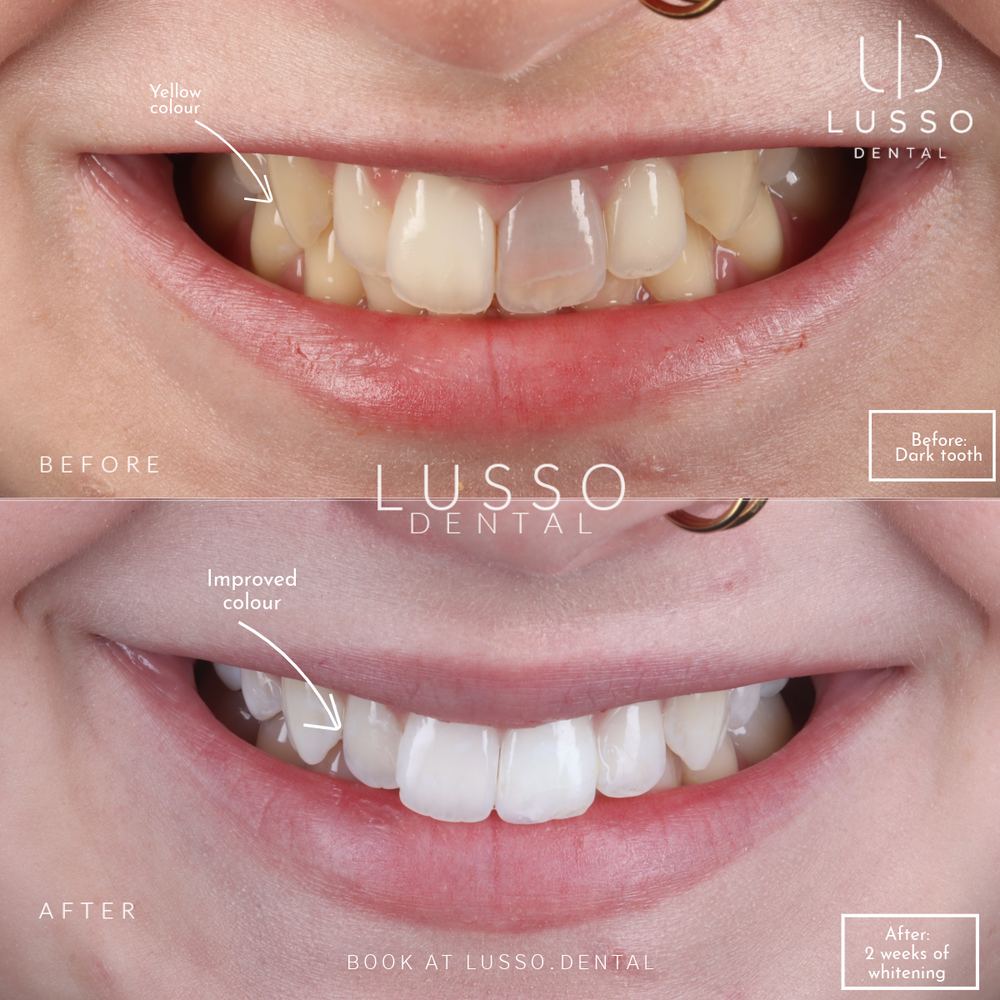 Teeth whitening, before and after case 5, Dr Kal's own work