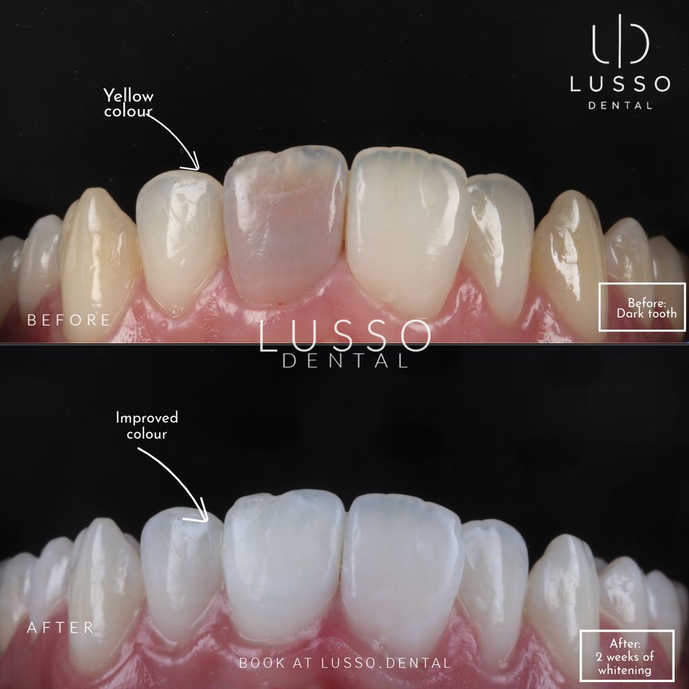 Teeth whitening, before and after case 6, Dr Kal's own work