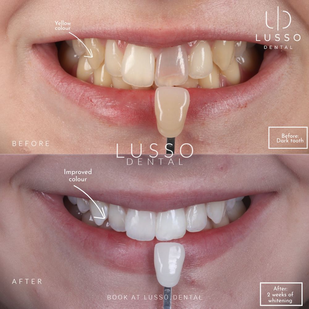 Teeth whitening, before and after case 7, Dr Kal's own work