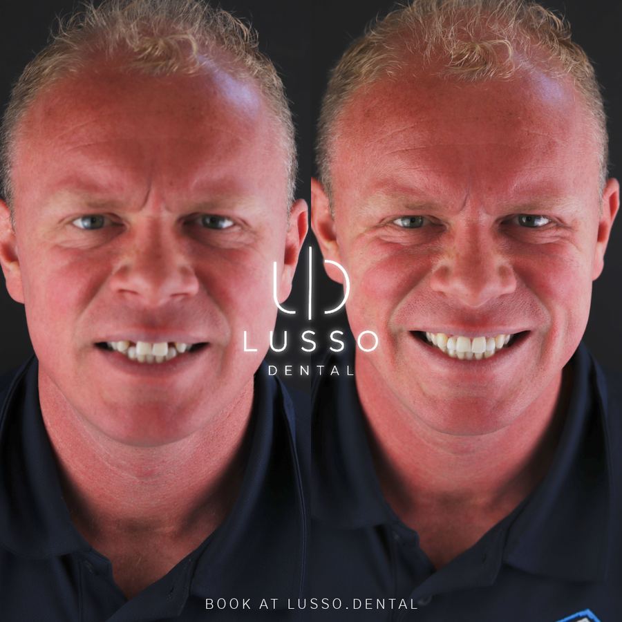 Before and after full face view: a worn smile rebuilt