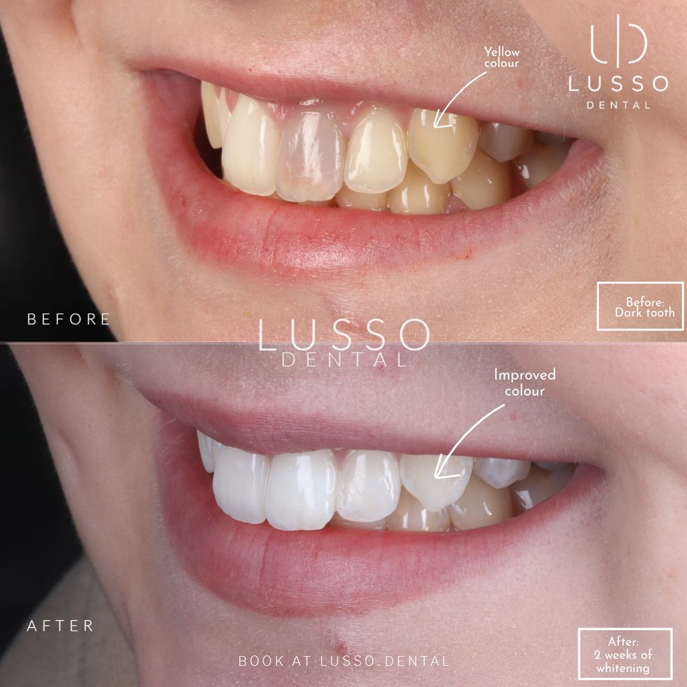 Is teeth whitening safe for your enamel?